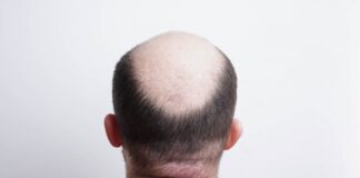 Έρχεται το εμβόλιο για τη φαλάκρα